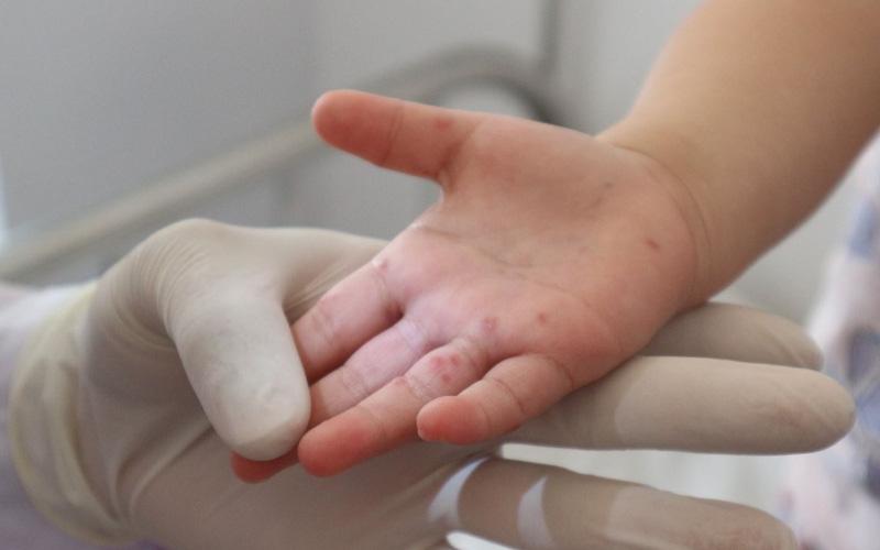 Cách phòng tránh các bệnh truyền nhiễm thường gặp khi giao mùa