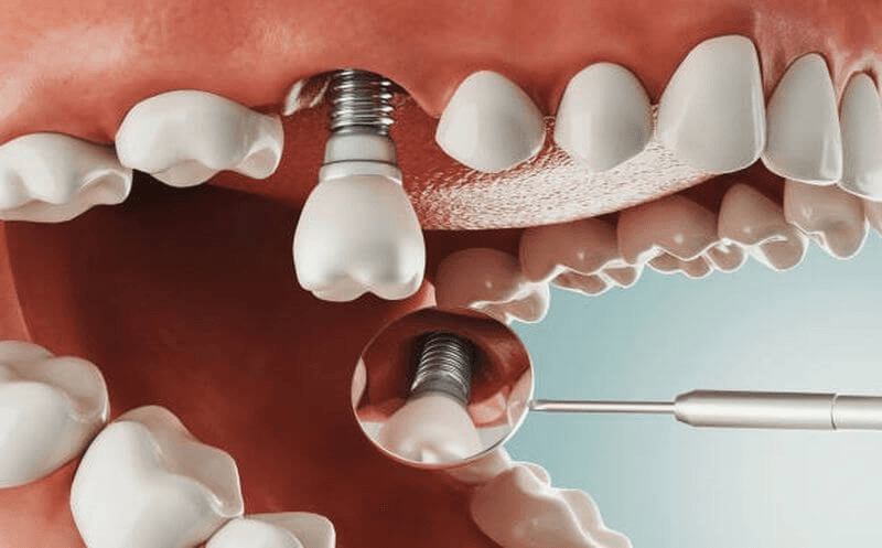 Trồng răng implant chất lượng hàng đầu tại Bệnh viện Răng Hàm Mặt