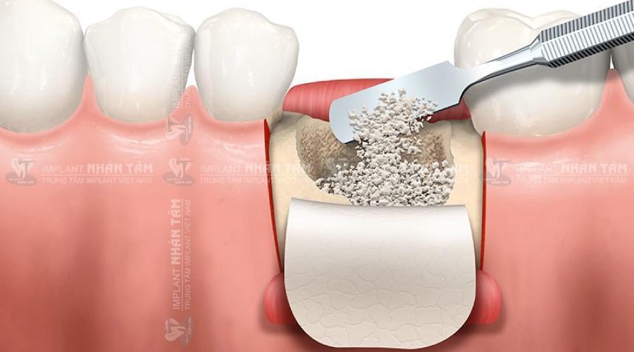 Giá trồng răng Implant bao nhiêu tại Trung tâm Implant Việt Nam?