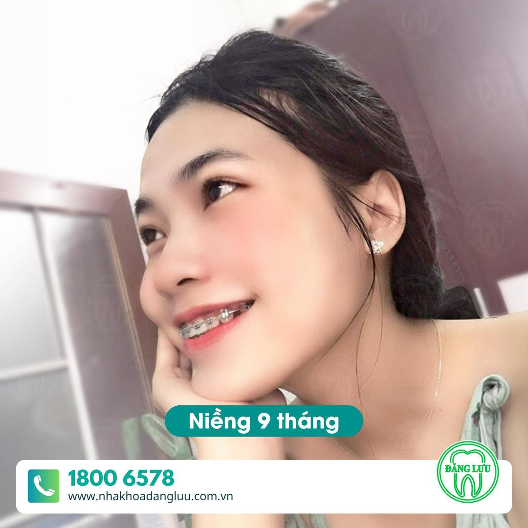 Ưu điểm của phương pháp niềng răng tại Nha Khoa Đăng Lưu